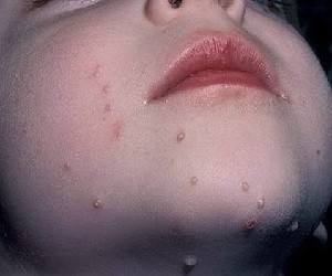 контагиозный моллюск у детей лечение комаровский