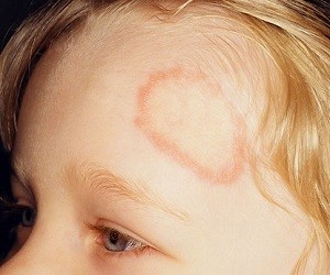 розовый лишай у детей фото симптомы и лечение