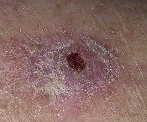 рак кожи лечение