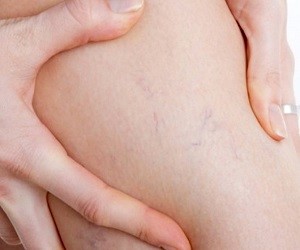 Сосуды лопаются при беременности на ногах thumbnail