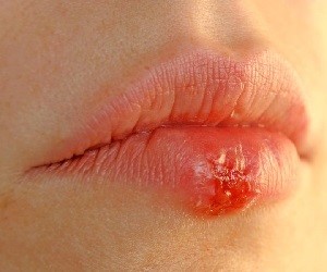 Герпес на губах может повлиять на беременность thumbnail