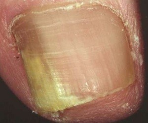 микоз ногтей лечение