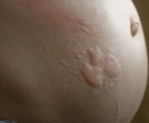 препараты от аллергии при беременности