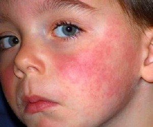 аллергия на солнце у ребенка фото