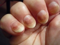 как выглядит грибок ногтей на руках