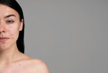 Достижения в лечении рубцов от угревой сыпи