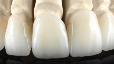 Что такое безметалловые коронки E.max: описание и особенности