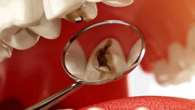 Где и как лечить кариес? Где и как лечить кариес?