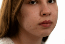 Гель от прыщей: руководство по выбору и использованию