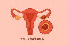 Диагностика и лечение кисты яичника у женщин