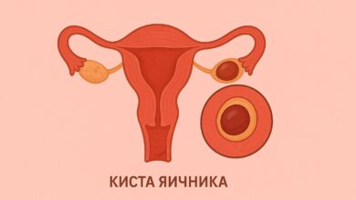 Диагностика и лечение кисты яичника у женщин